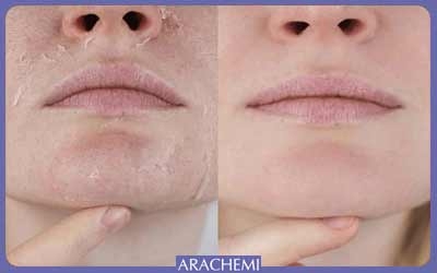 نقش تغذیه در سلامت پوست